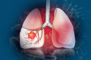 Ung thư phổi là bệnh hô hấp đồng mắc với COPD