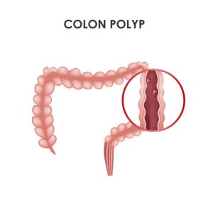 Polyp đại tràng là yếu tố nguy cơ của ung thư đại tràng