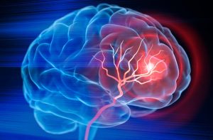 Kỹ thuật tDCS hỗ trợ cải thiện chức năng chi trên trên người bệnh đột quỵ não.