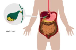 dẫn lưu túi mật xuyên gan qua da (PTGBD) được chỉ định cho viêm túi mật cấp mức độ trung bình (grade II), và viêm túi mật cấp nặng (grade III)