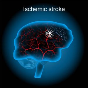 Đột quỵ thiếu máu não (Ischemic Stroke) là một loại đột quỵ xảy ra do tắc nghẽn động mạch