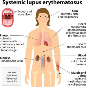 Bệnh phổi kẽ ở người bệnh Lupus ban đỏ hệ thống