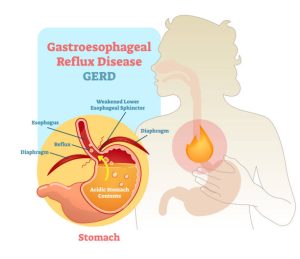 Trào ngược dạ dày thực quản gây nên nhiều triệu chứng khó chịu cho bệnh nhân