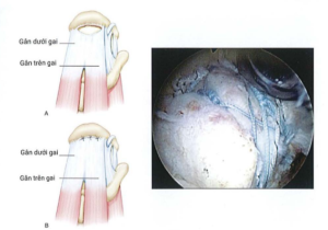 ảnh minh họa: Rách hình chữ c và khâu lại và kỹ thuật khâu bắc cầu Nguồn: AANA Advanced Arthroscopy (2010), The Shoulder