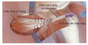 ảnh minh họa: Chuyển phần thấp cơ thang Nguồn: Joaquin Sanchez-Sotelo, Mayo Clinic