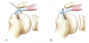 ảnh minh họa : Hình dạng mỏm cùng vai, A: hình phẳng, B; hình cong, C: hình móc Nguồn: Burkhart s.s, et al (2006), Lìppincotte Williams & Wilkins Philadelphia