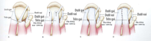 ảnh minh họa: Kỹ thuật trượt đôi Nguồn: AANA Advanced Arthroscopy (2010), The Shoulder