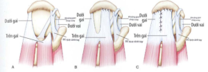 ảnh minh họa: Kỹ thuật trượt đơn Nguồn: AANA Advanced Arthroscopy (20 JO), The Shoulder