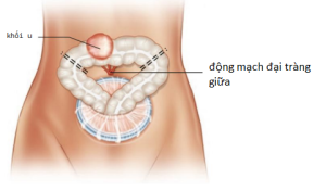 Cắt đại tràng