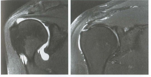 ảnh minh họa: MRI rách bán phần gan trân gai