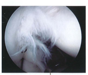 ảnh minh họa: Phân chóp xoay bị rách tưa Nguồn: AANA Advanced Arthroscopy (2010), The Shoulder