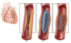 kĩ thuật dặt stent mạch vành