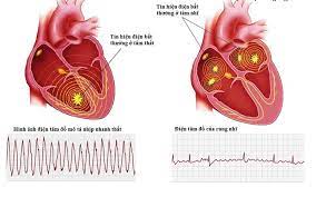 Thuốc điều trị rối loạn nhịp tim