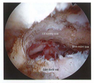 ảnh minh họa: Tạo hình mỏm quạ Nguồn: AANA Advanced Arthroscopy (2010), The Shoulder