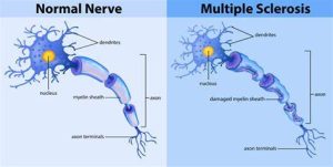 Huỷ myelin cấp