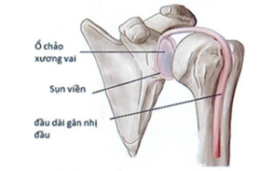 Ảnh minh họa: Đầu dài gân cơ nhị