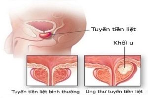 minh-hoa-ung-thu-tien-liet-tuyen