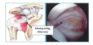 Ảnh minh họa khoảng trống chóp xoay