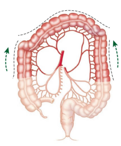 cắt đại tràng