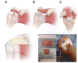 ảnh minh họa: Chuyển phần thấp cơ thang Nguồn: Joaquin Sanchez-Sotelo, Mayo Clinic