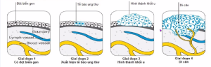 cac-giai-doan-phat-trien-của-ung-thu