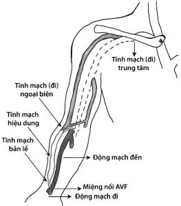 Các thành phần của một cầu nối đường vào mạch máu (AVF) tại cổ tay