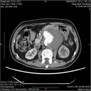 Hình, ảnh khối phình động mạch chủ bụng vỡ