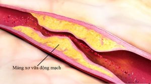 Bệnh động mạch chi trên do xơ vữa