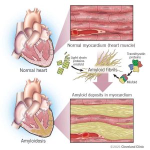 Amyloidosis