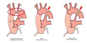 hẹp eo động mạch chủ