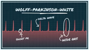 Hội chứng Wolff-Parkinson-White