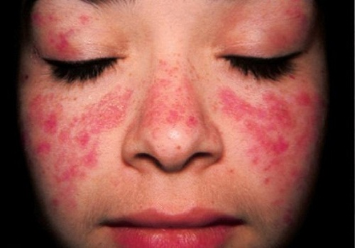 Ban cánh bướm ở bệnh Lupus ban đỏ hệ thống