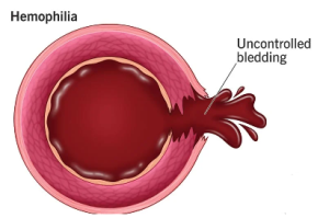 Bệnh máu khó đông (Hemophilia)