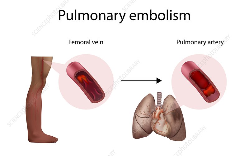 pulmonary-embolism