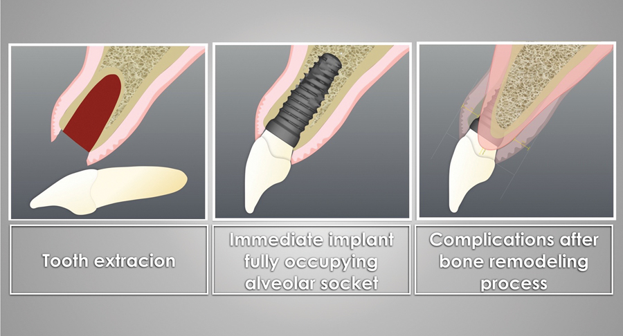 dat-implant-tuc-thi