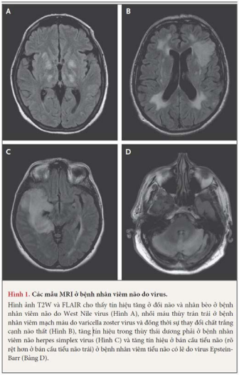 MRI-nao-o-benh-nhan-viem-nao-do-virus