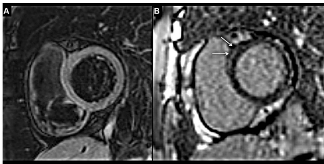 MRI-tim-benh-nhan-hau-covid