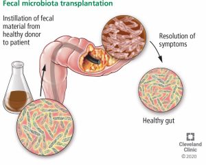 Tái phát nhiễm trùng Clostridium difficile