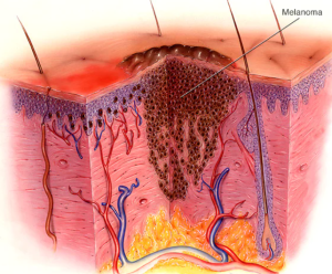Ung thư hắc tố da