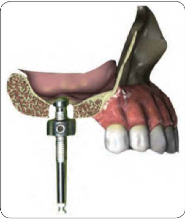 implant-tuc-thi-2