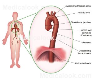 Viêm động mạch chủ