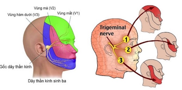 Đau dây thần kinh tam thoa liên quan với herpes zoster virus