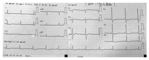 Điện tâm đồ bệnh nhân hội chứng động mạch vành mạn.