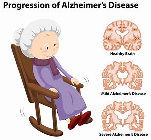 tien-trien-cua-benh-Alzheimer