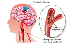 hình ảnh minh họa cơn thiếu máu não thoáng qua