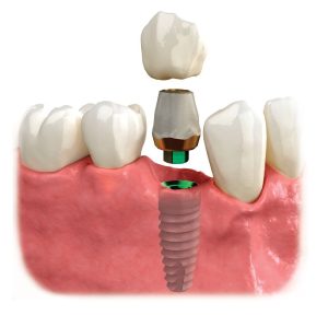 phuc-hinh-implant-bat-vit