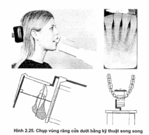 Chụp phim cận chóp bằng kĩ thuật song song cho vùng răng cửa hàm dưới