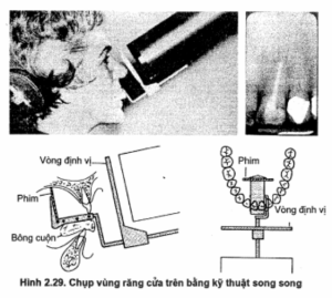 Phim cận chóp kỹ thuật song song răng cửa trên