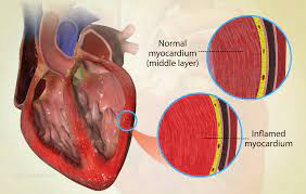 Viêm cơ tim