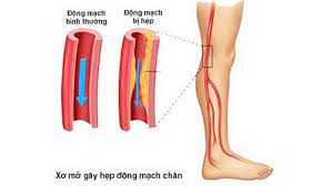 Dưới cấp tính năng tắc động chi